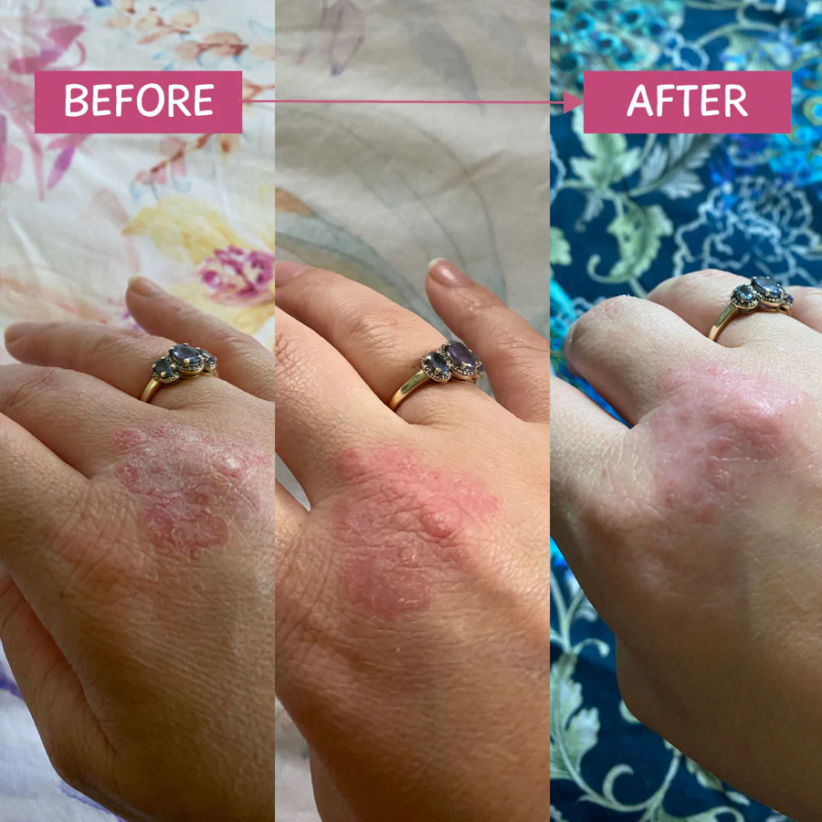 MooGoo Pink Eczema Cream 120g